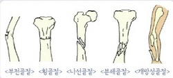 부전골절, 횡골절, 나선골절, 분쇄골절, 개방성골절